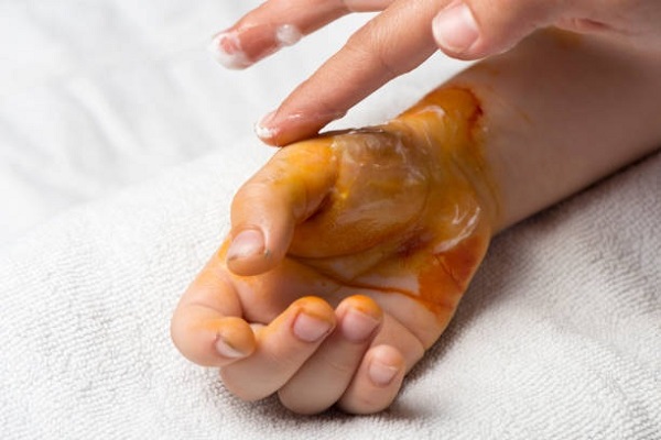 Queman a una niña de 11 años en un centro de rehabilitación en Tonalá, Jalisco