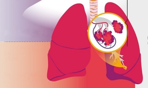 Puebla, pionera en investigación en enfermedades pulmonares crónicas por caída ceniza